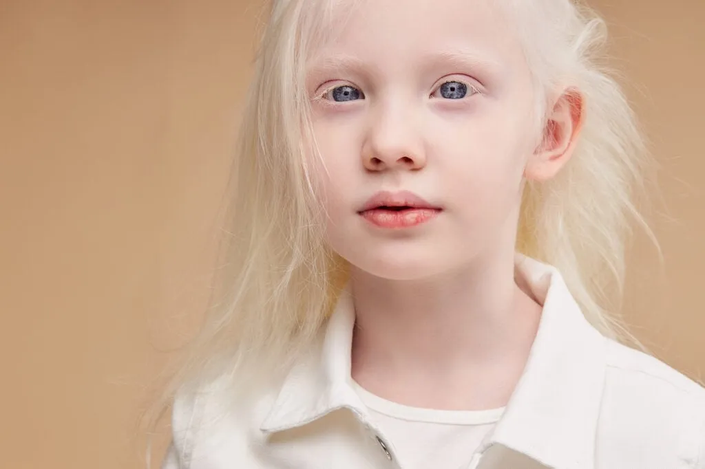 What Causes Albinism? 1