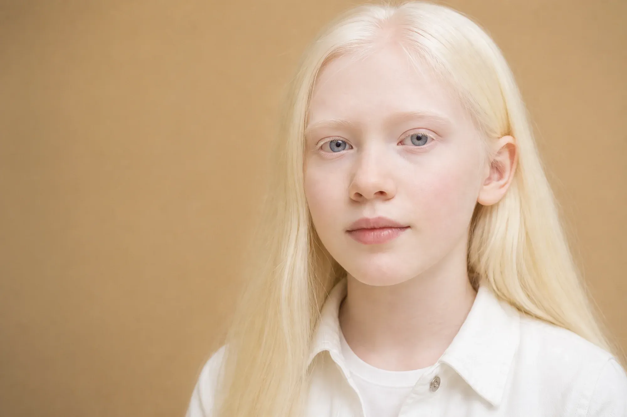 What Causes Albinism? 1