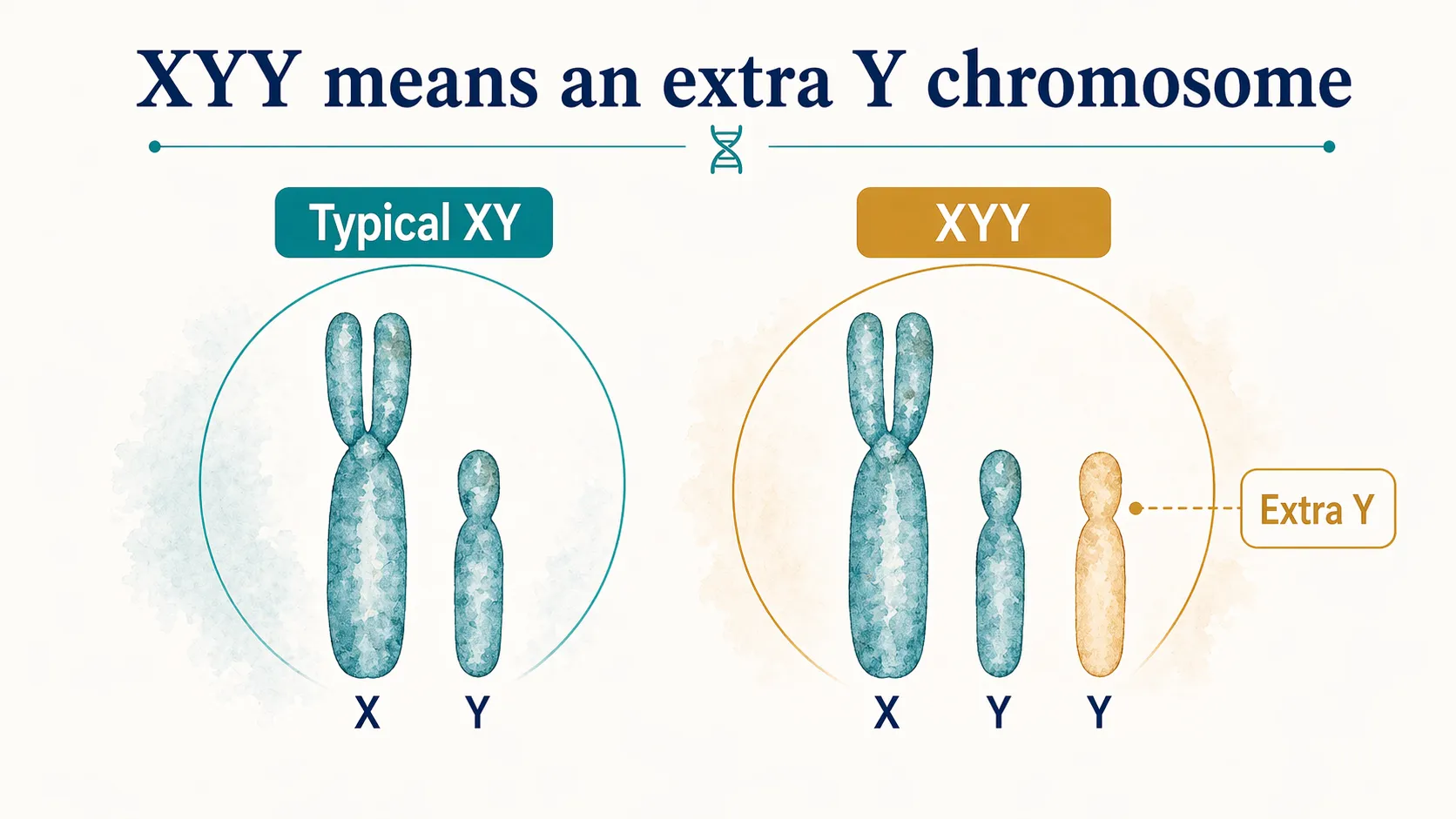 XYY syndrome graphic showing typical XY chromosomes and an extra Y chromosome.
